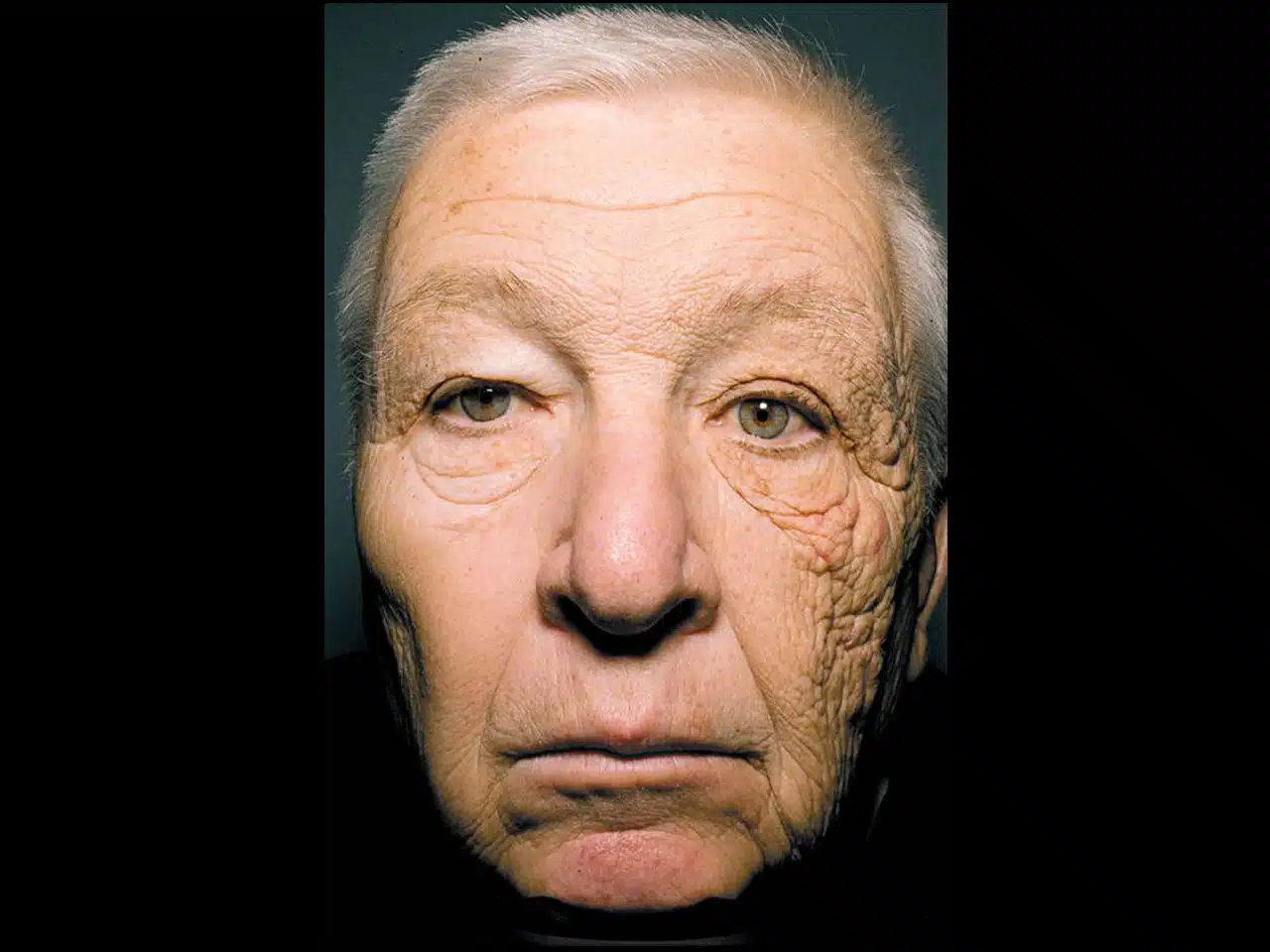 Sun damaged skin of a truck driver.